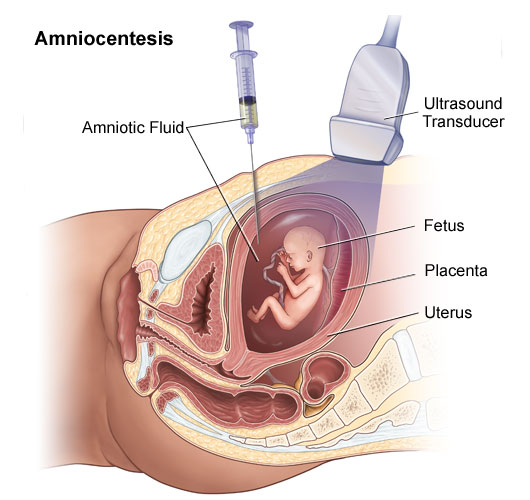 What are the advantages and disadvantages of amniocentesis?